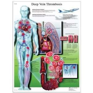   Deep Vein Thrombosis Anatomical Chart, Poster Size 20 Width x 26