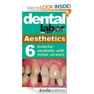 Anterior aesthetic with metal ceramic (dental lab technology articles 