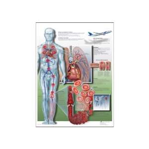   Deep Vein Thrombosis Anatomical Chart, French) Poster Size 20 Width x